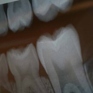 Hill City Dental X-Rays